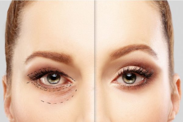 Blefaroplastia O Que Super Moderna